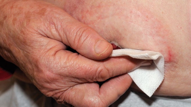 die Hand das Stoma reinigt