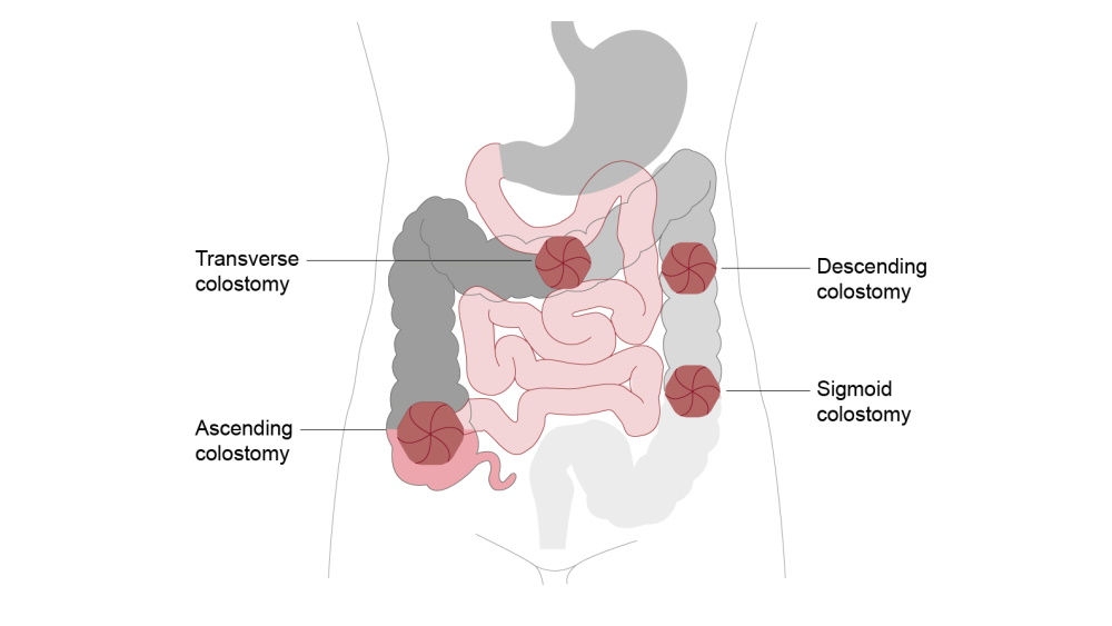 illustrazione di colostomia trasversale, discendente, ascendente e sigmoidea