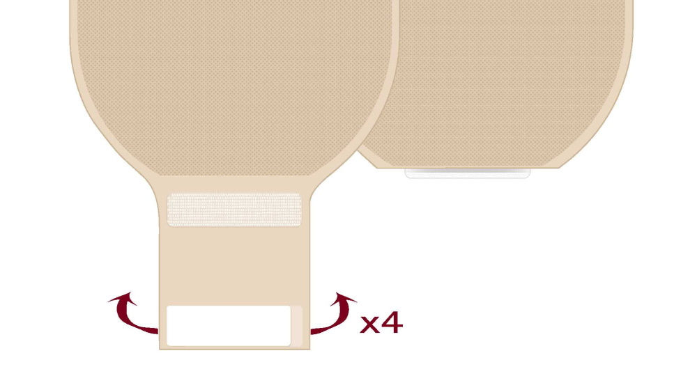 Ileostomabeutel schließen