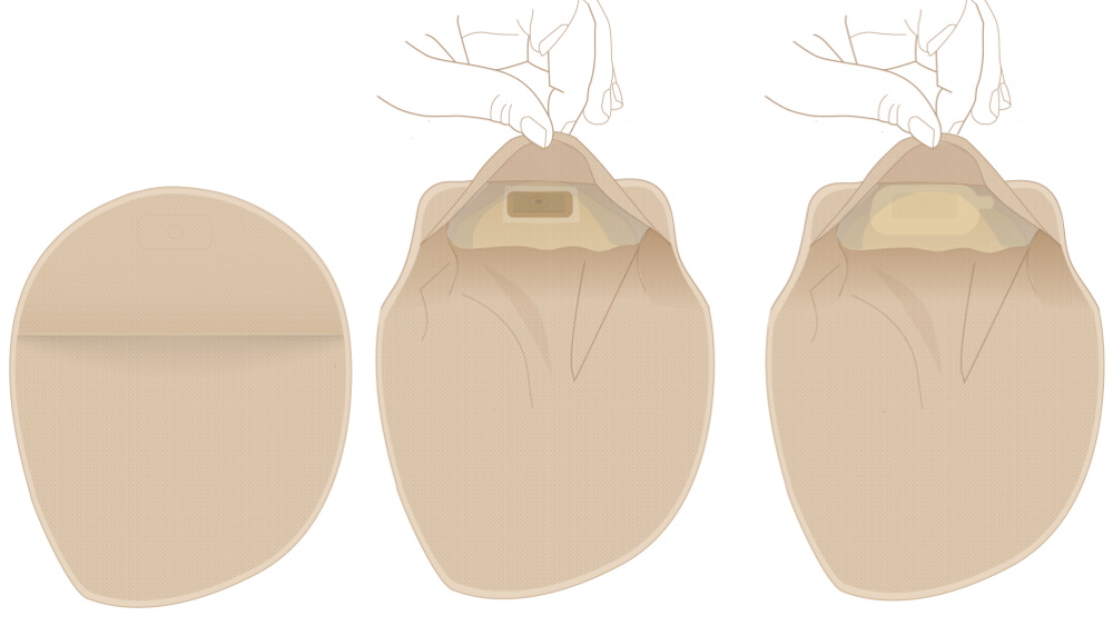 手がストーマバッグのフィルターを覆っている