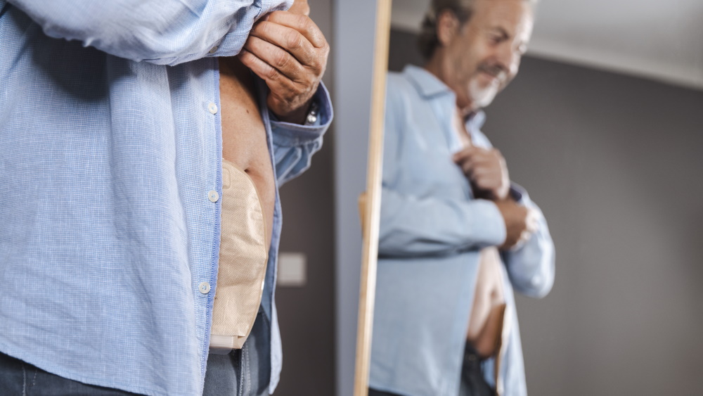 Um homem de meia idade com um saco de ostomia em frente a um espelho a abotoar a sua camisa